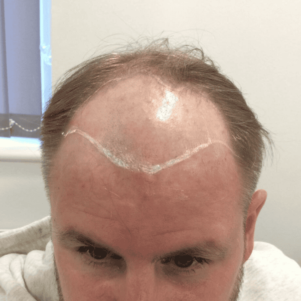 KSL hair transplant