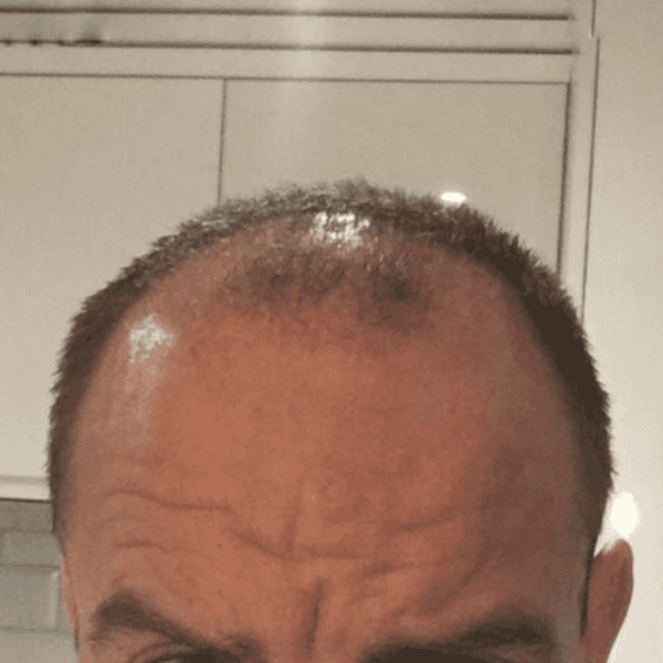 KSL hair transplant
