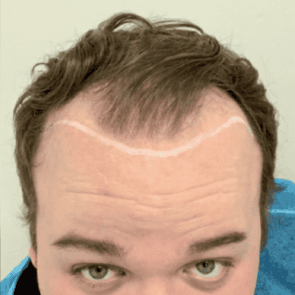 KSL hair transplant