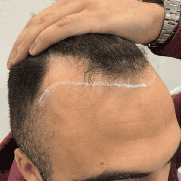 KSL hair transplant
