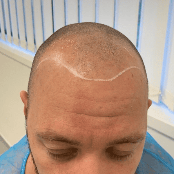 KSL hair transplant