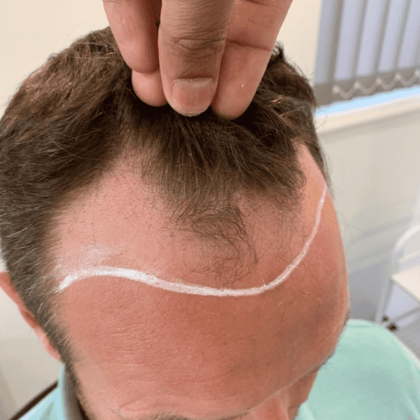 KSL hair transplant