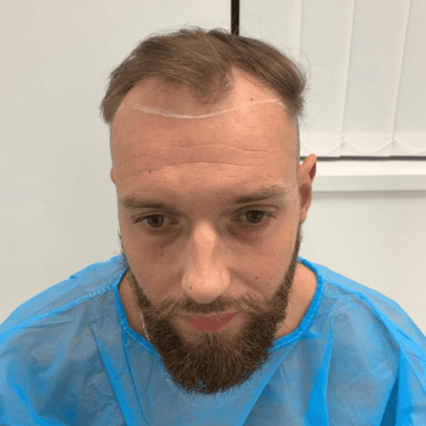 KSL hair transplant