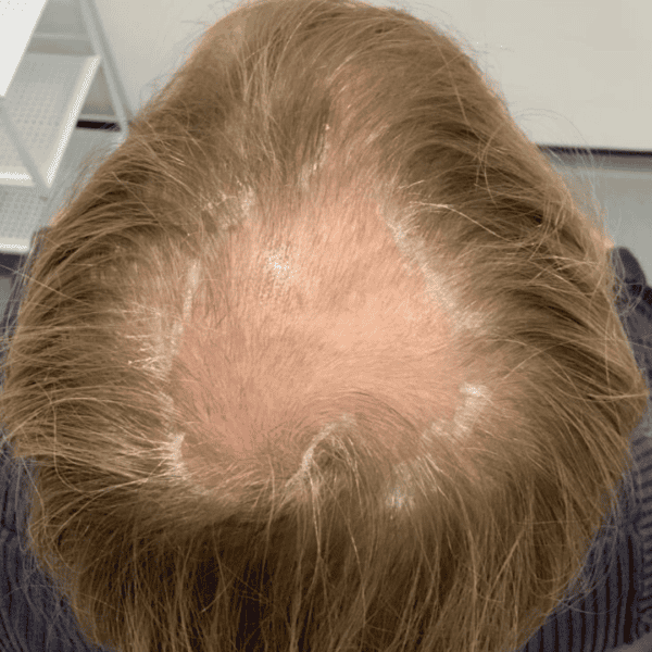 KSL hair transplant