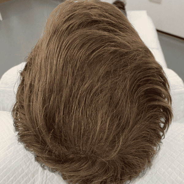 KSL hair transplant