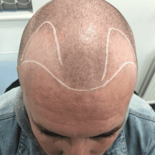 KSL hair transplant
