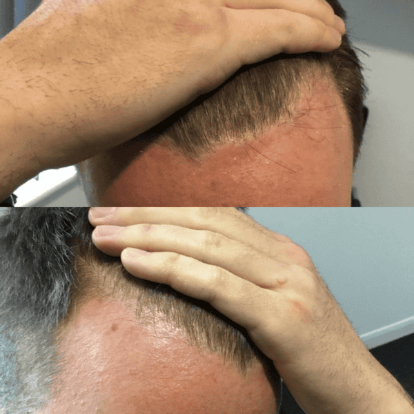 KSL hair transplant