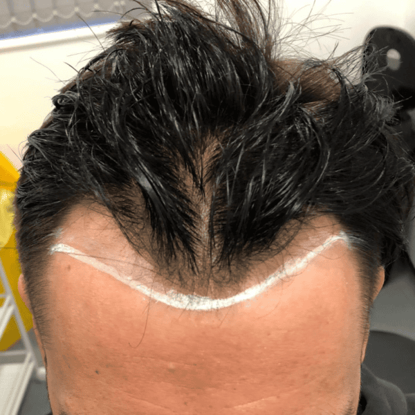 minoxidil after hair transplant