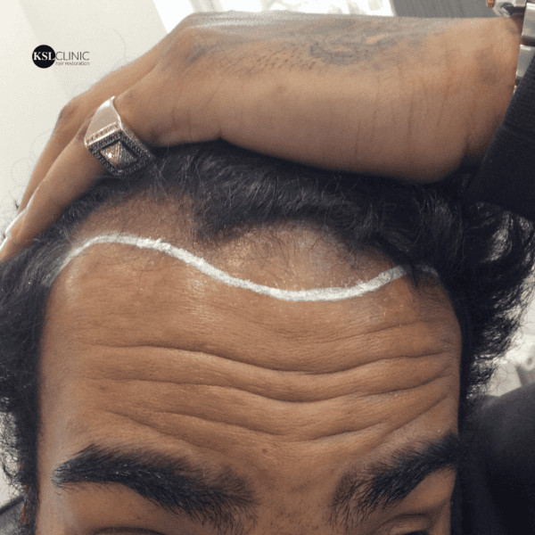 KSL hair transplant