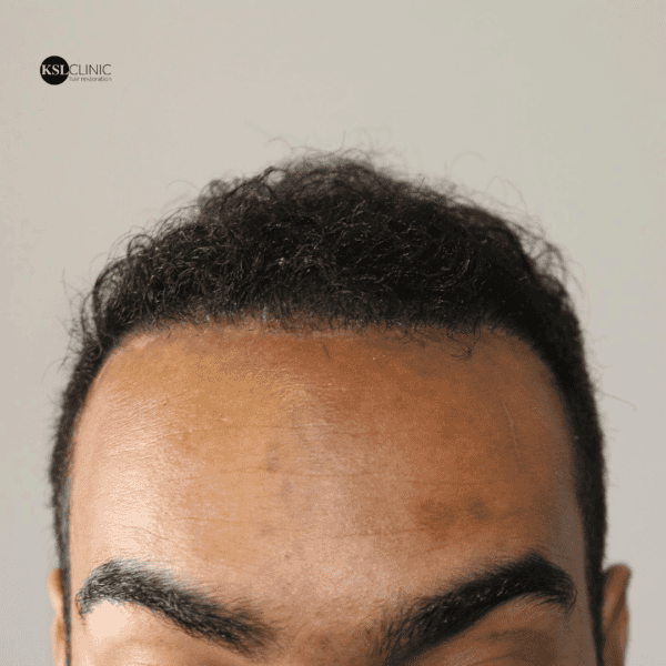 KSL hair transplant
