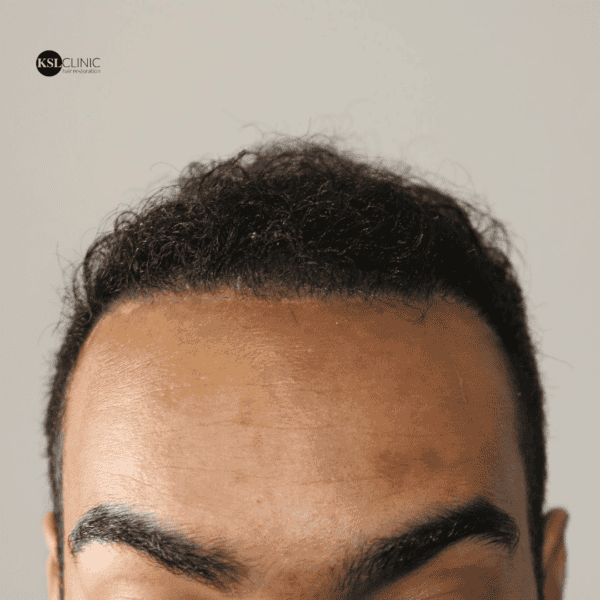 KSL hair transplant