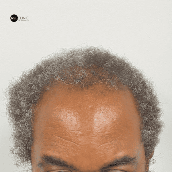 KSL hair transplant