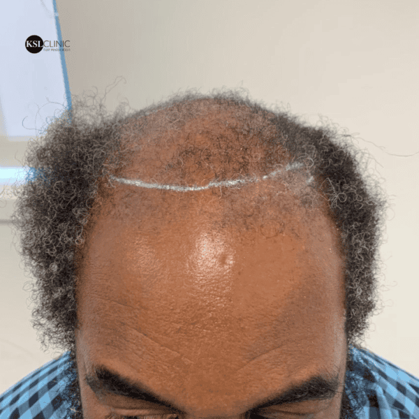 KSL hair transplant