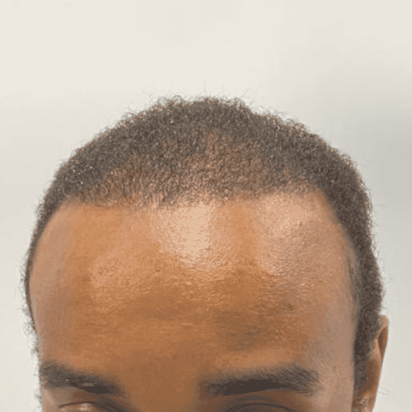 KSL hair transplant