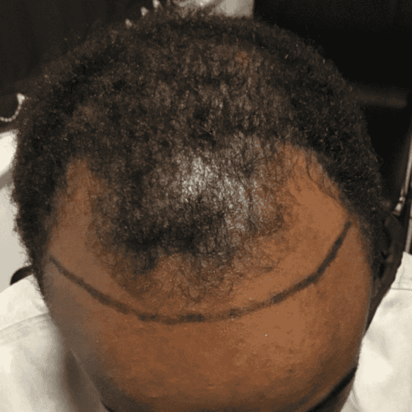 KSL hair transplant