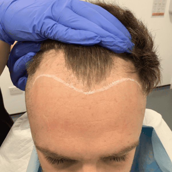 KSL hair transplant