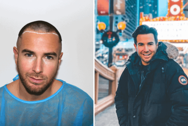 KSL hair transplant