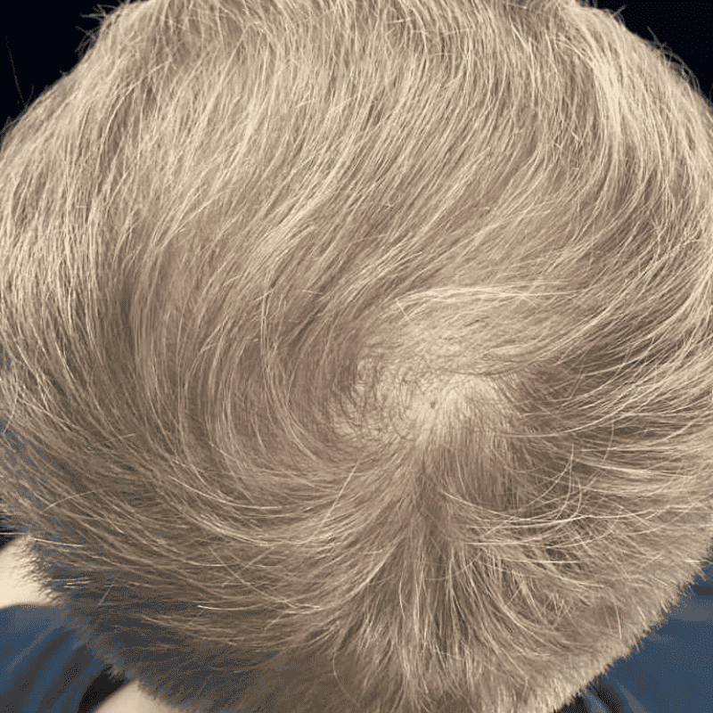 KSL hair transplant