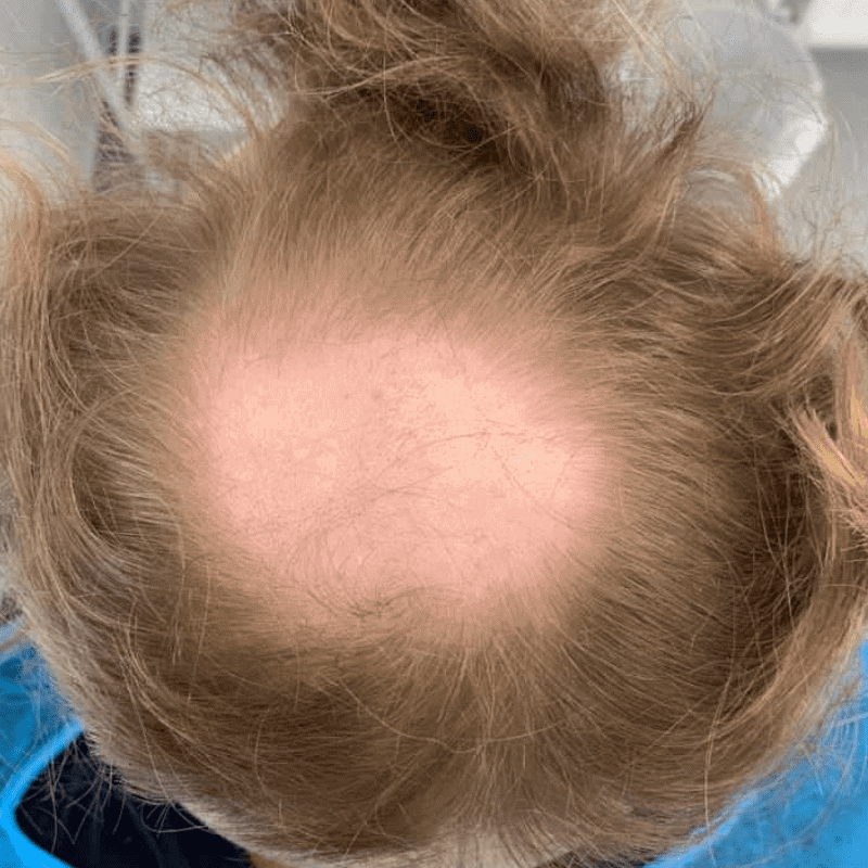 Hair Transplant After 2 Weeks – What to Expect