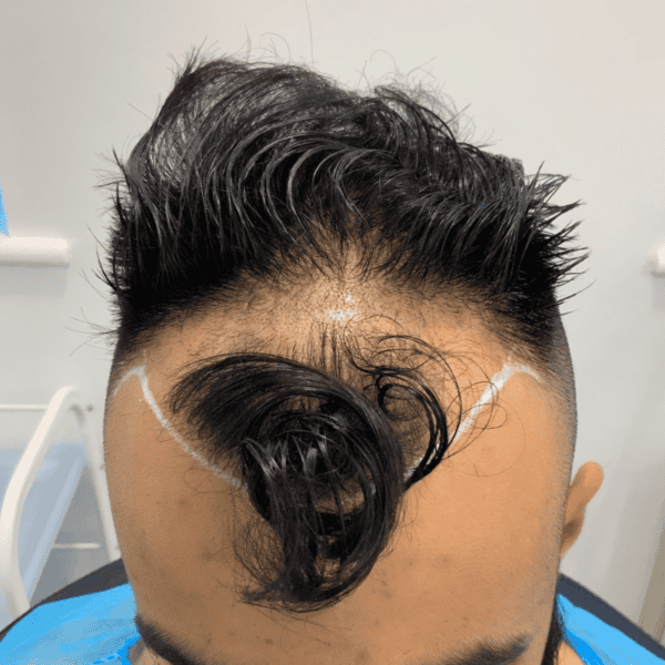 KSL hair transplant