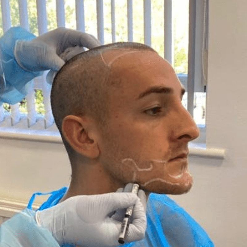 KSL hair transplant