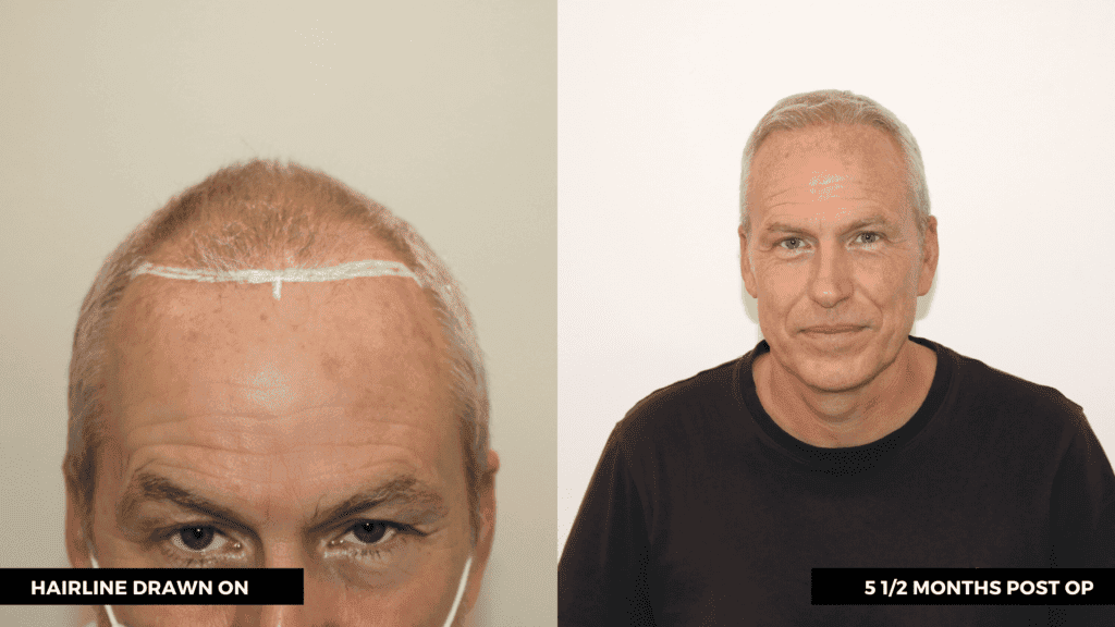 hair transplant southampton