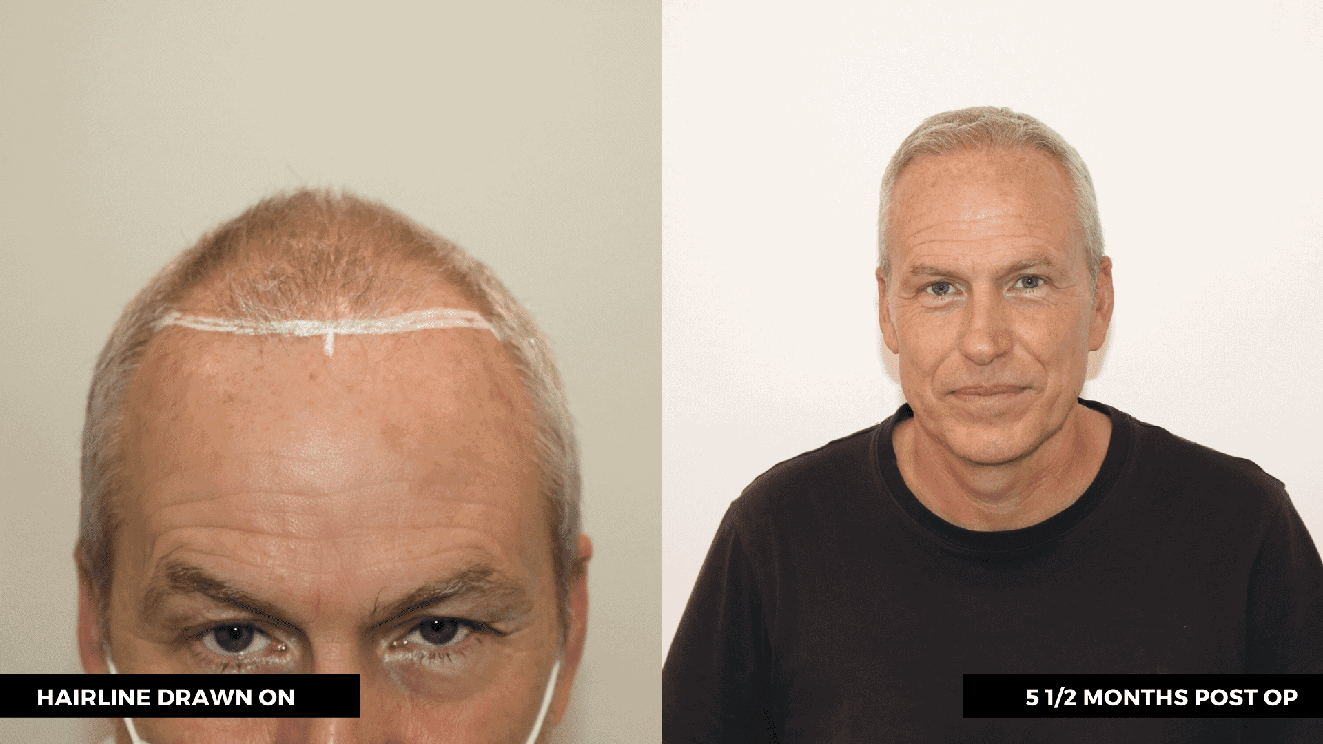hair transplant southampton