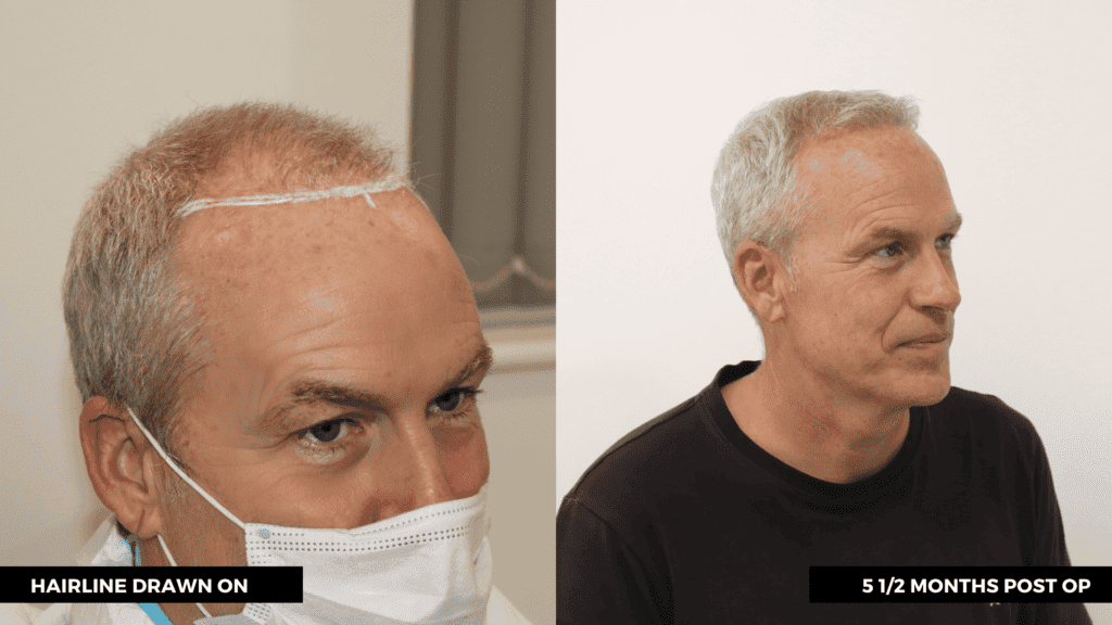 hair transplant graft cost