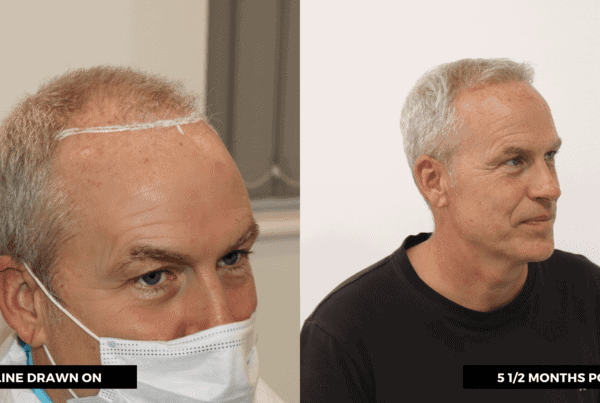 hair transplant graft cost
