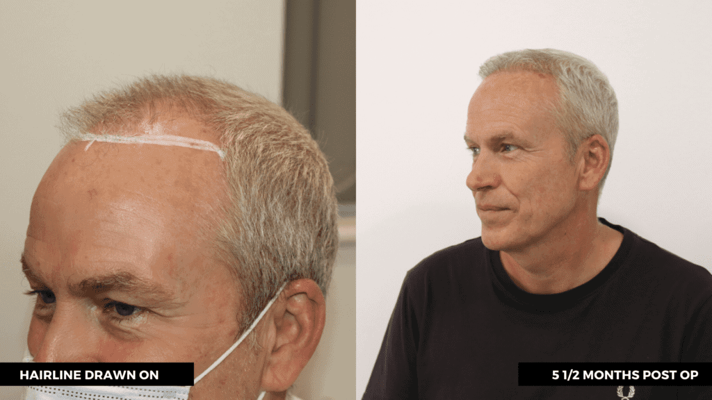 KSL-Clinic-Hair-Transplant