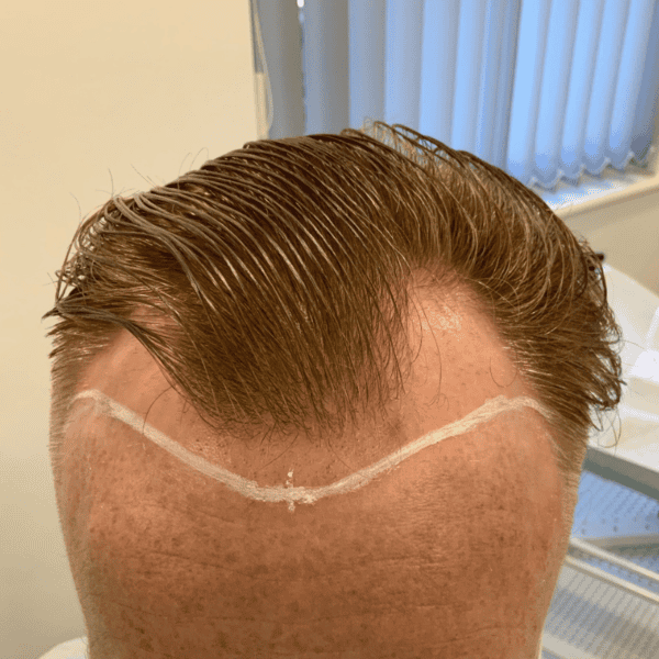 KSL hair transplant