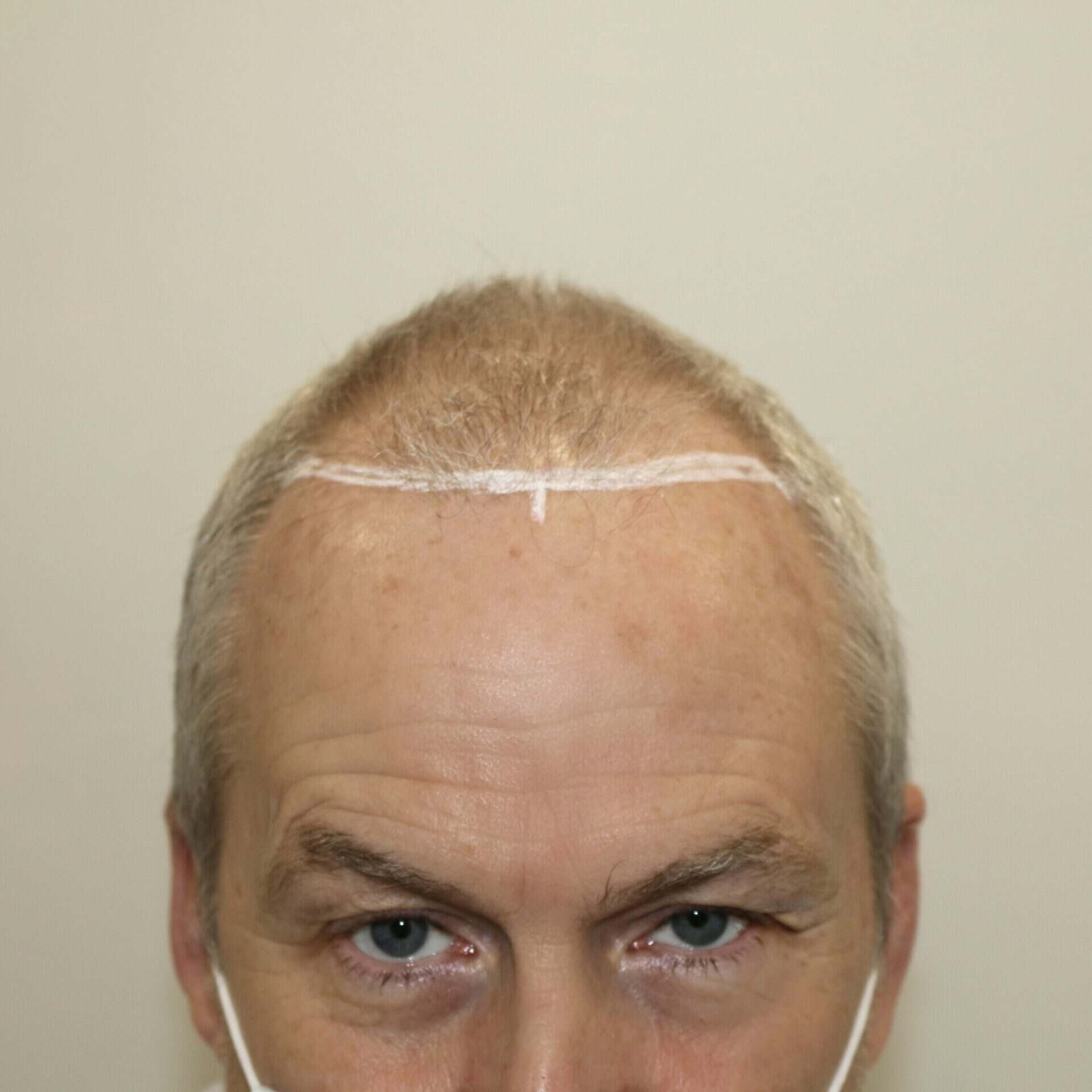 KSL-Clinic-Hair-Transplant