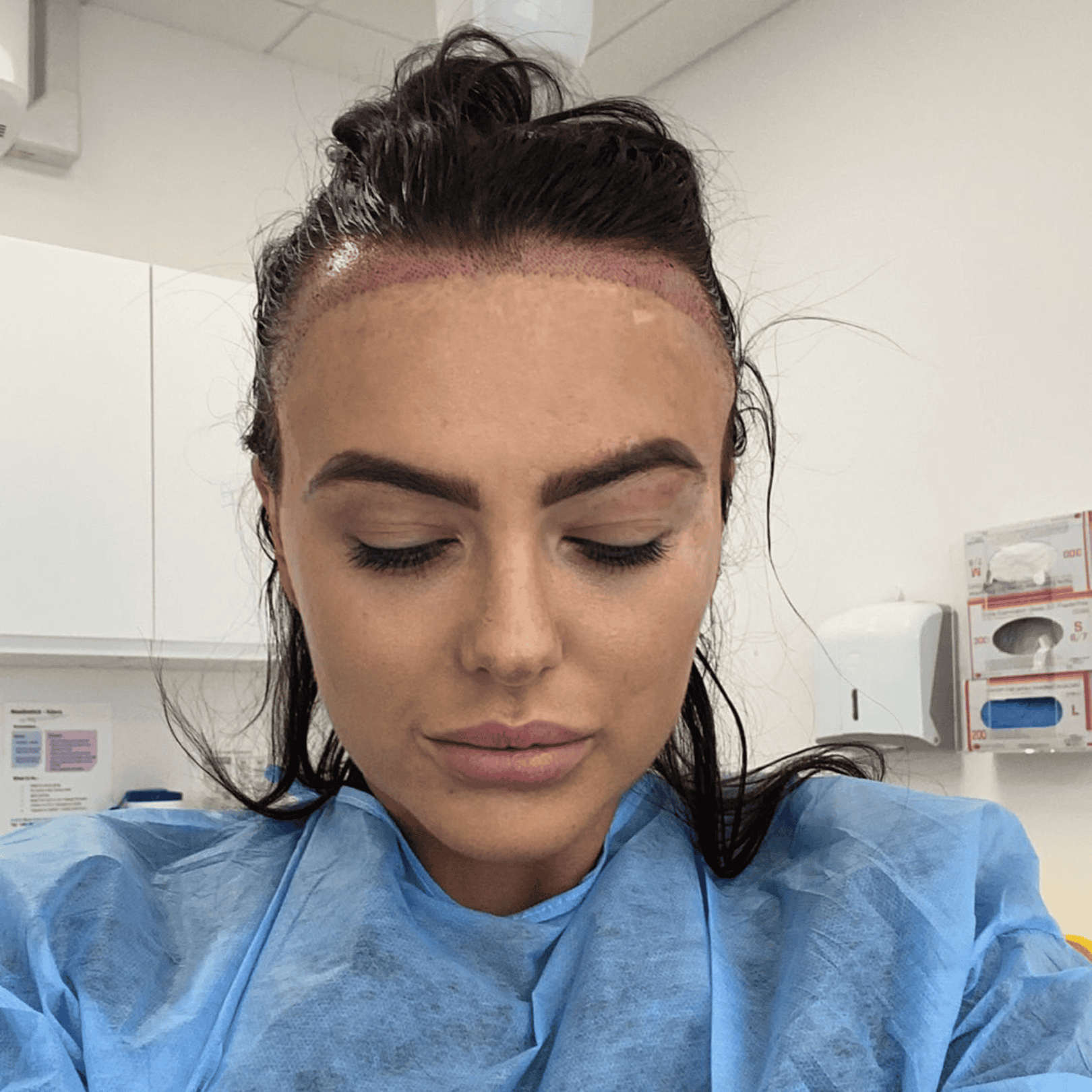Hair Transplant Liverpool | Free Consultation and costs | Hair Loss Clinic