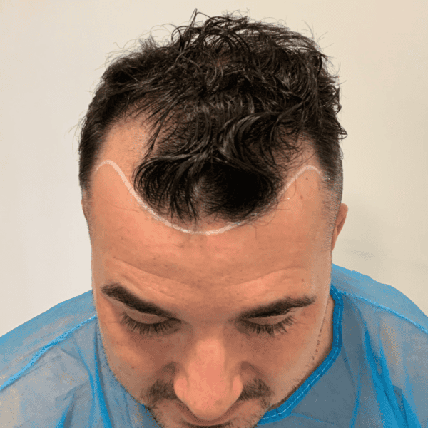 KSL hair transplant