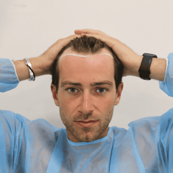 KSL-Clinic-Hair-Transplant