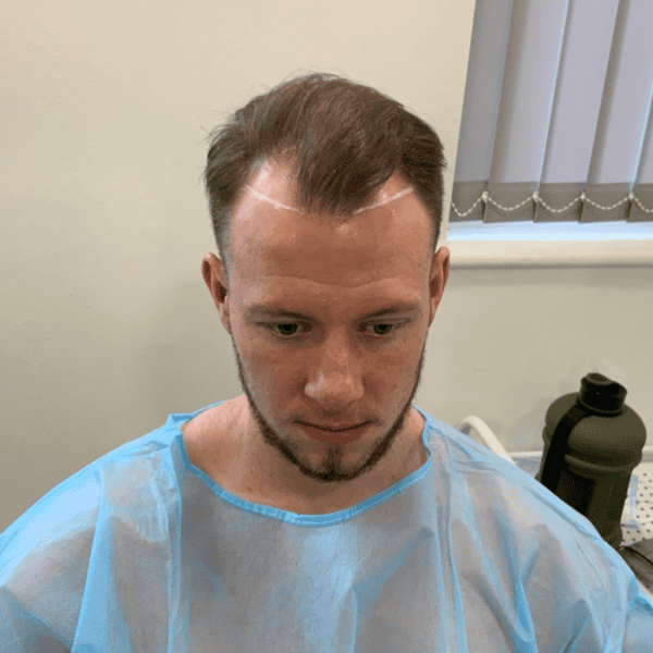 3 weeks after hair transplant