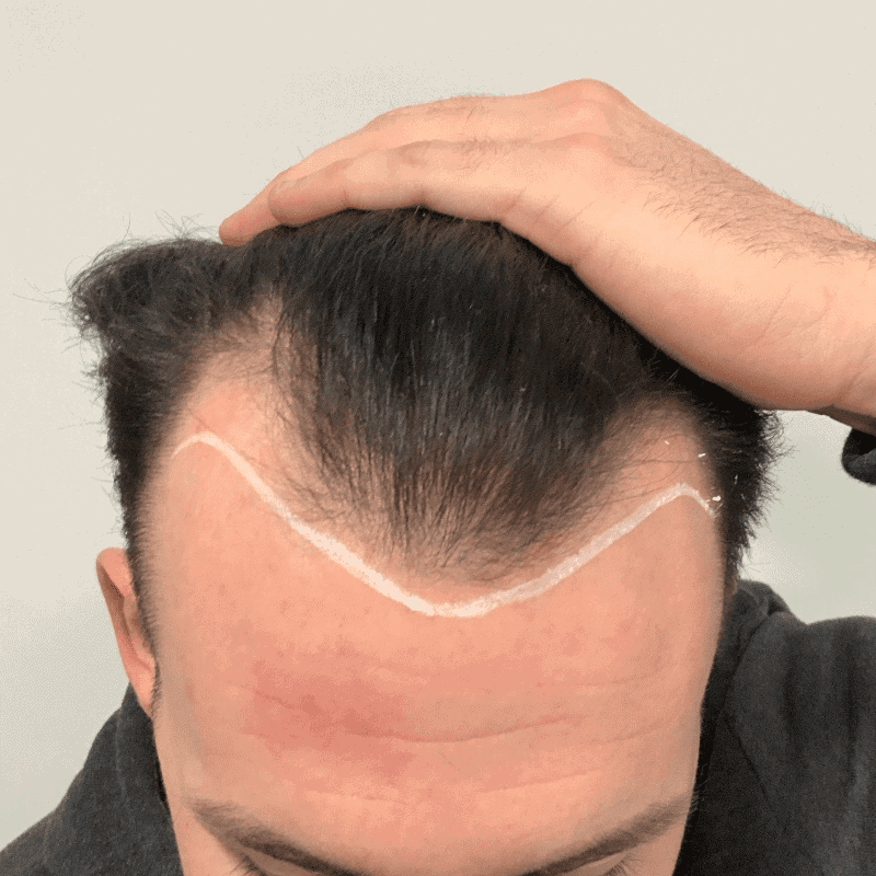KSL-Clinic-Hair-Transplant