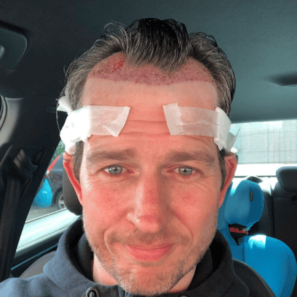 KSL-Clinic-Hair-Transplant