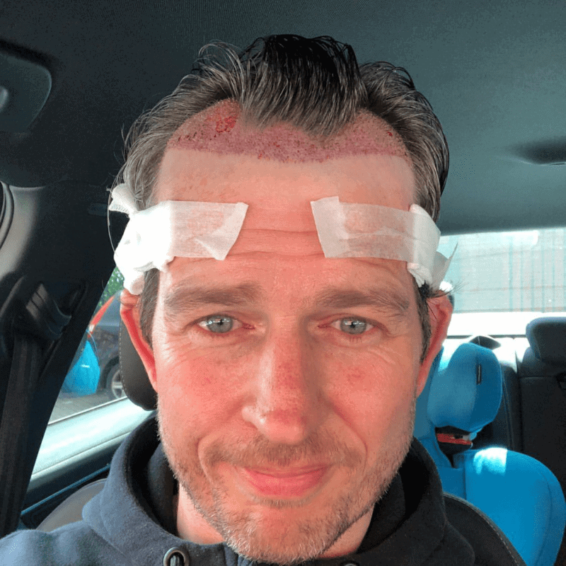 KSL-Clinic-Hair-Transplant