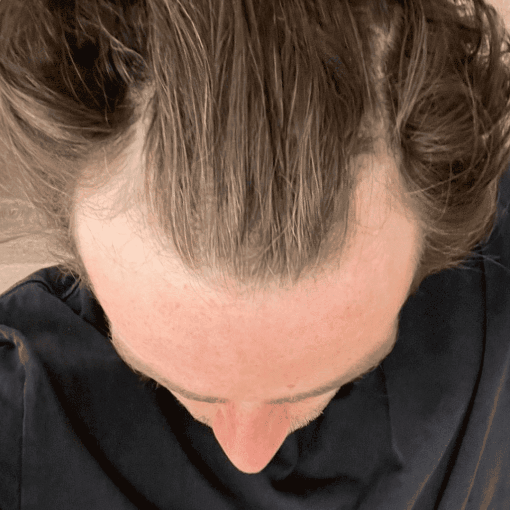 sleeping after hair transplant