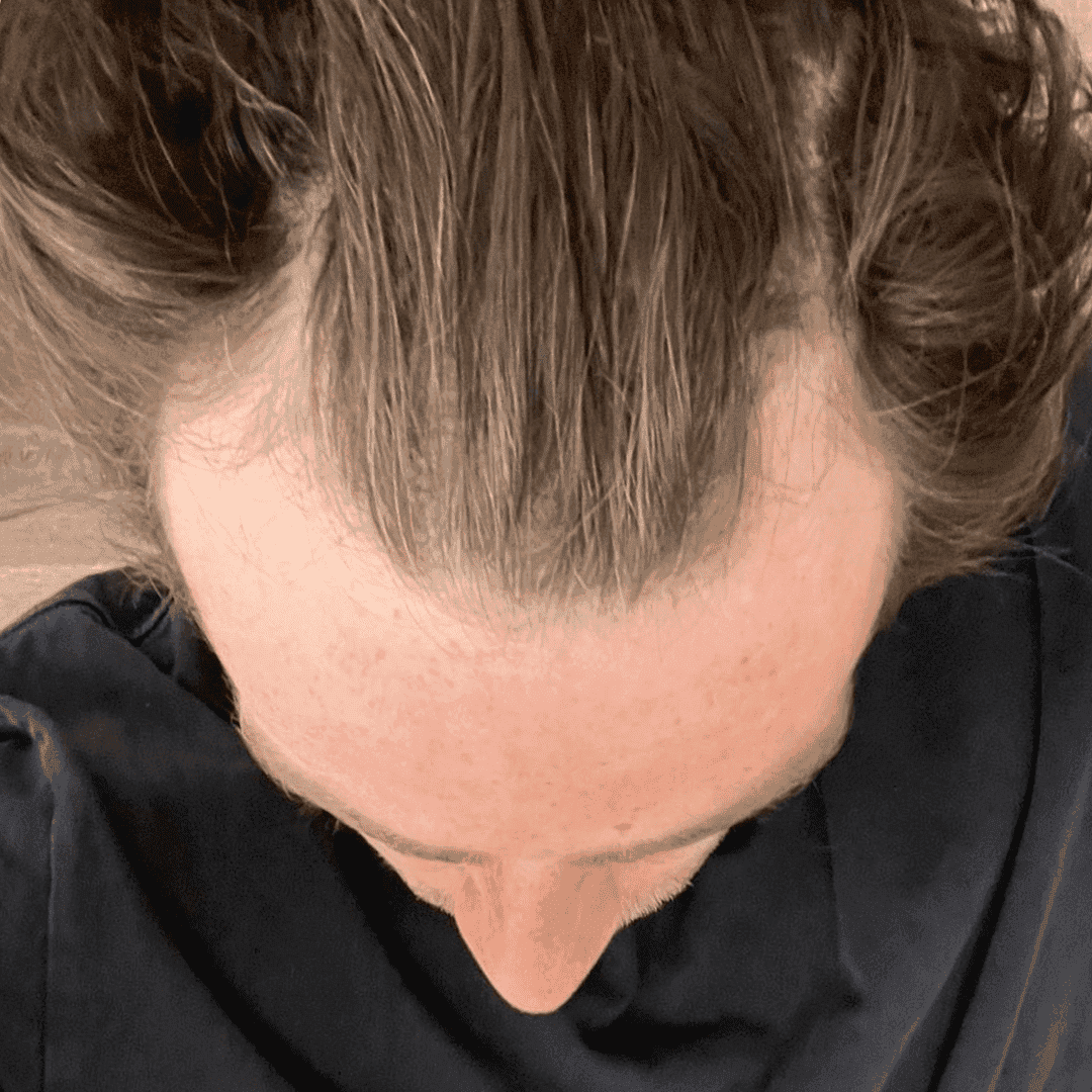 sleeping after hair transplant