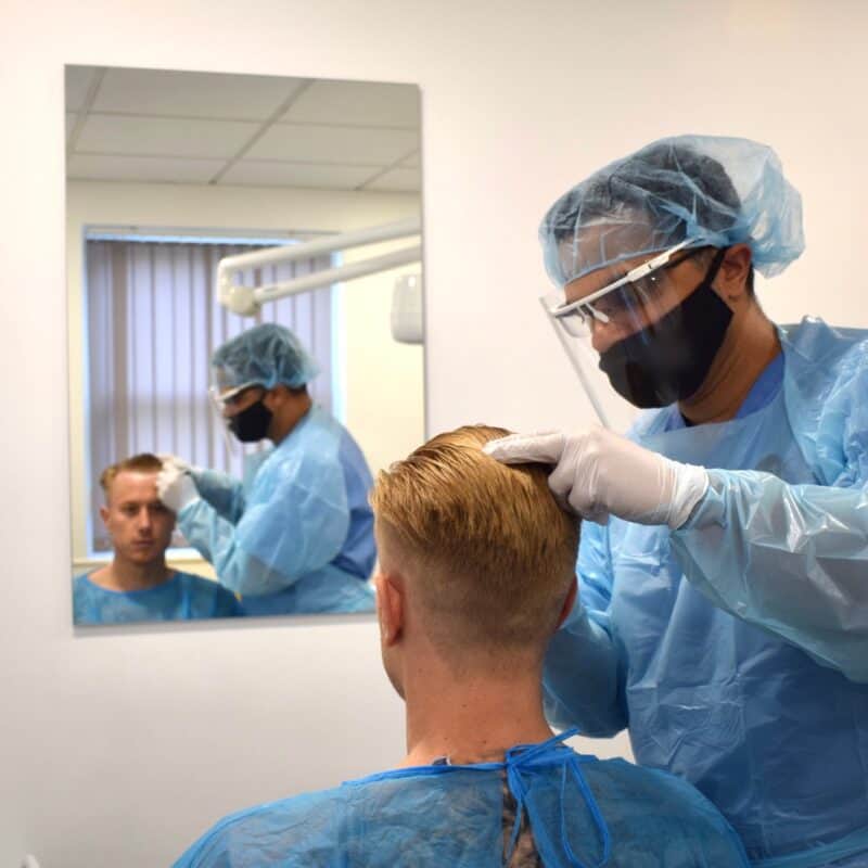 3 weeks after hair transplant