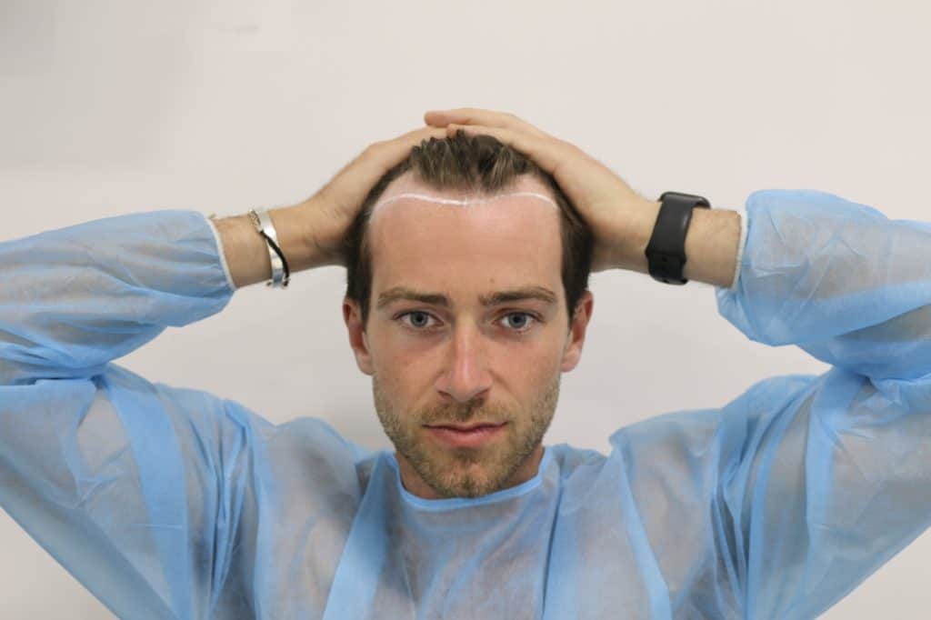 KSL-Clinic-Hair-Transplant