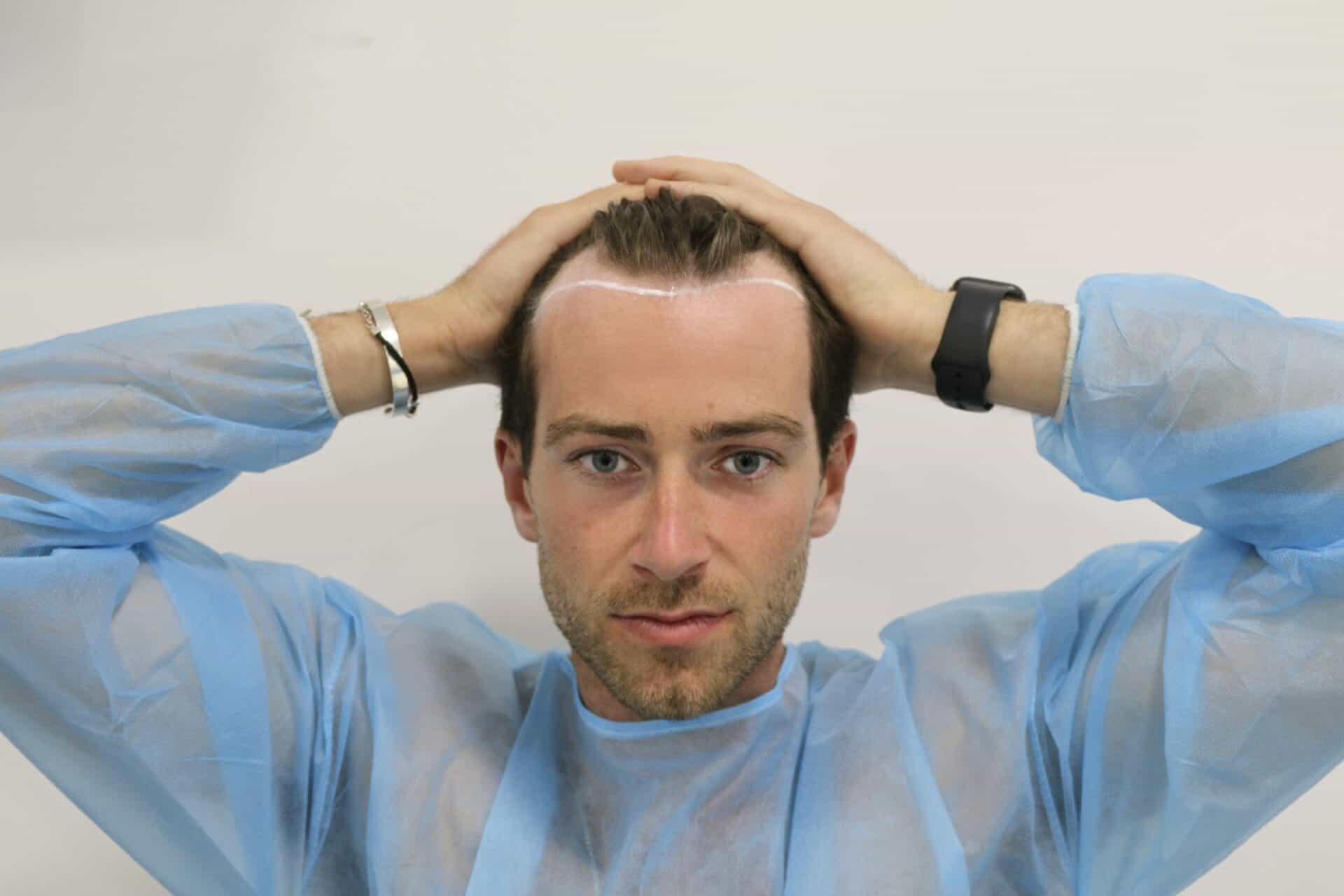 KSL-Clinic-Hair-Transplant