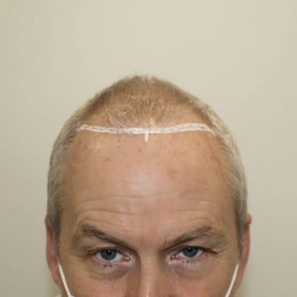 KSL-Clinic-Hair-Transplant