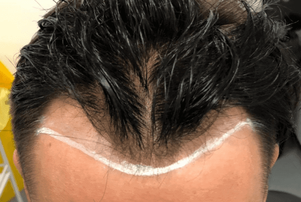 minoxidil after hair transplant