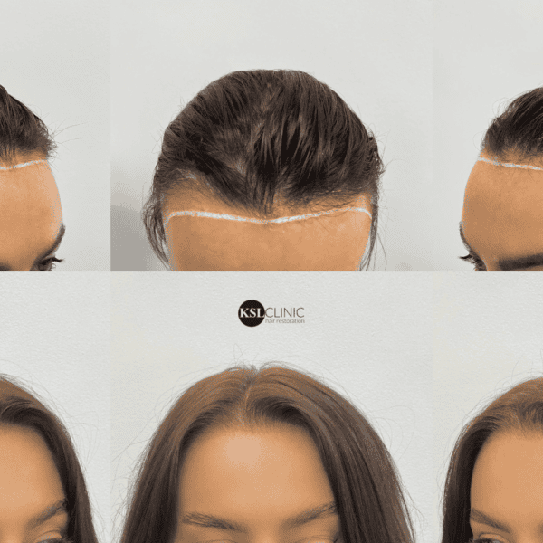 KSL-Clinic-Hair-Transplant