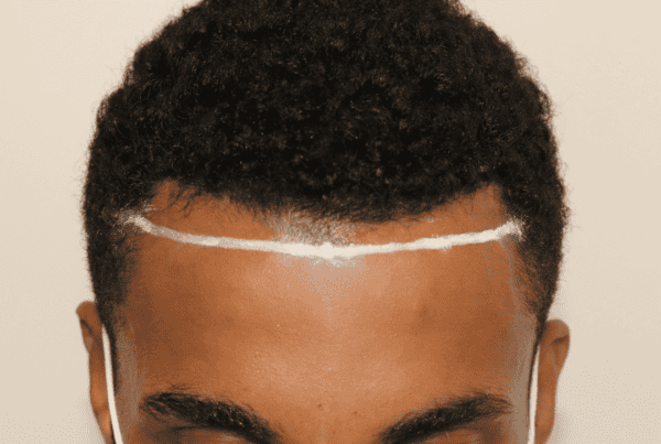 what to expect 10 days after a hair transplant