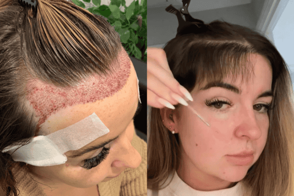 hair transplant woman