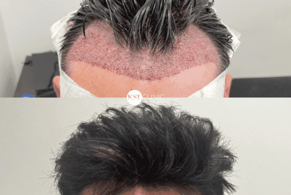 KSL-Clinic-Hair-Transplant-1